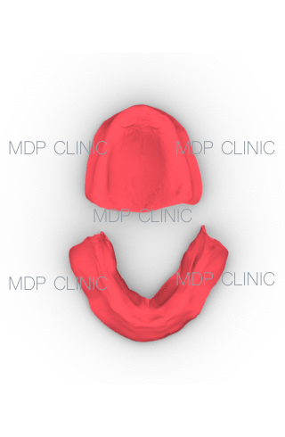 12 Elementi Dentari su 4 Impianti in Arcata Superiore. 12 Elementi Dentari su altrettanti 4 Impianti in Arcata Inferiore